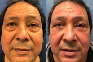 Avant et après chirurgie des paupières à Tirana, Albanie pour un regard jeune.