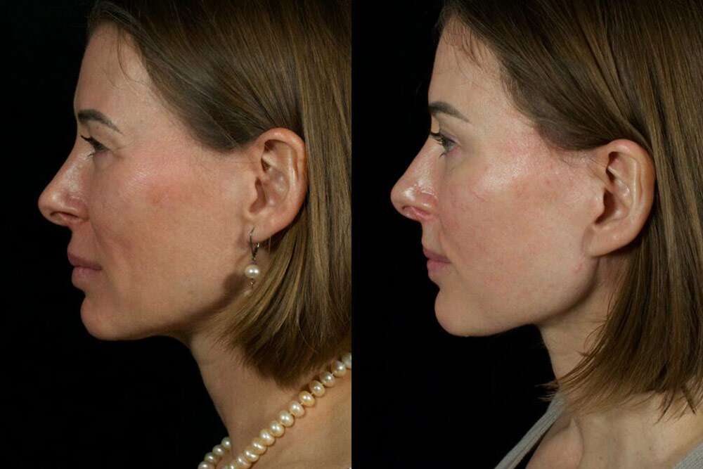 Γυναίκα lip lift καταπληκτικό πριν και μετά τα αποτελέσματα