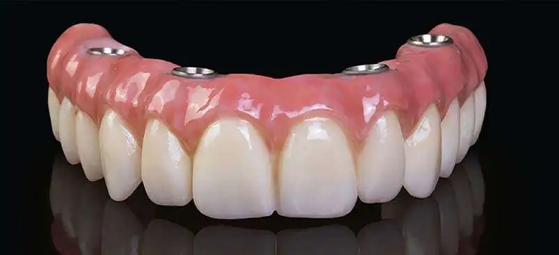 Tandheelkundige implantaten in Albanië.