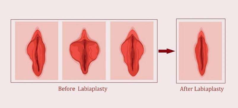 Labiaplastika në Shqipëri