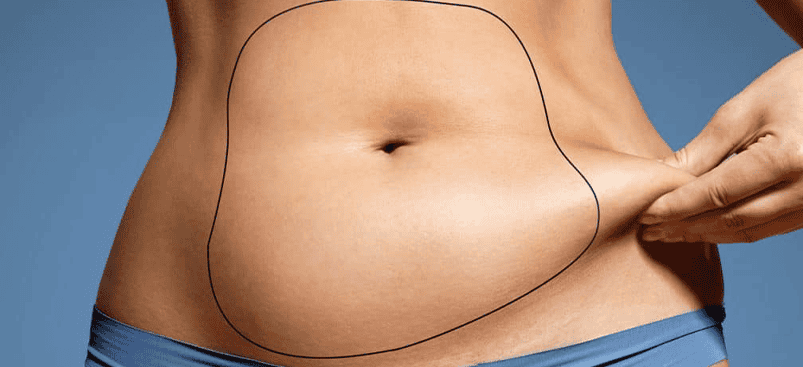 Liposuccion Albanie procédure d'élimination des graisses.