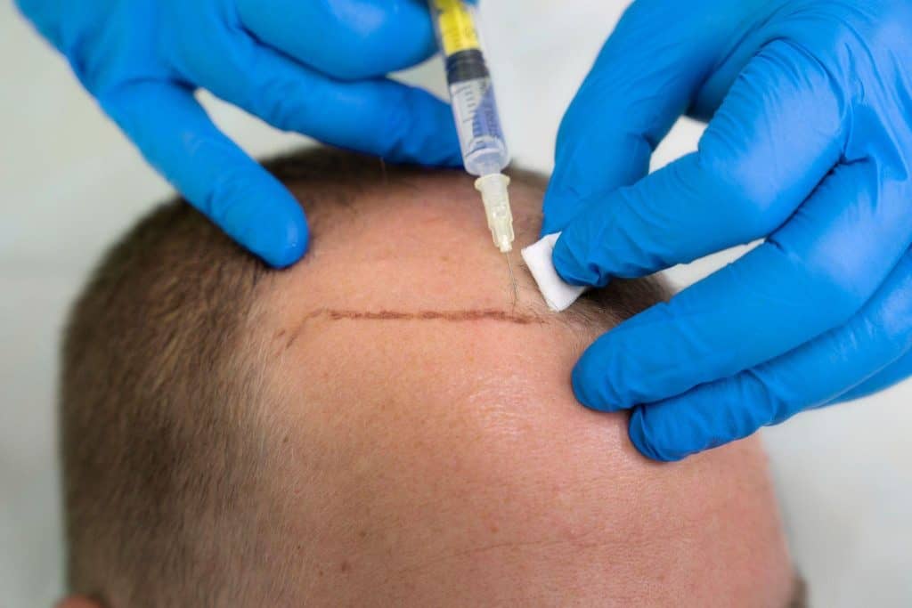 Specjalista medyczny wykonujący zabieg transplantacji włosów w Albanii.