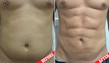 Male abdomen before and after cosmetic surgery in Albania.