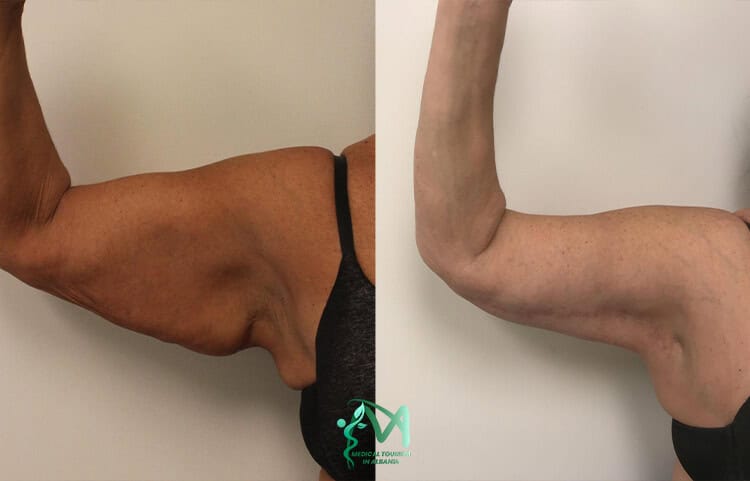 Arm Lift before and after surgery in Albania.