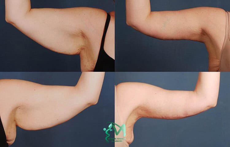 Arm lifting in Albania procedure patients before-and-after recovery.