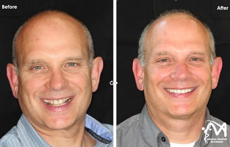 Before and after dental implants in Albania, male patient smiling in the photo.