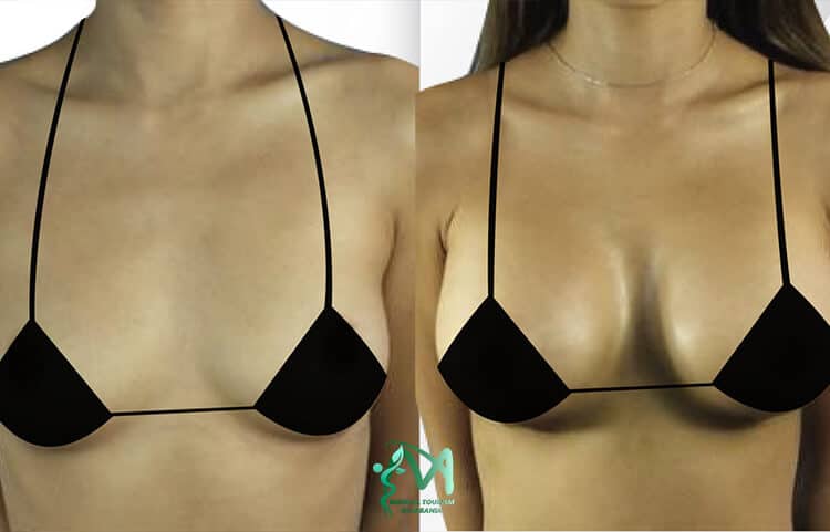 Breast enlargement surgery Albania