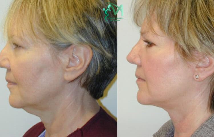 Chin lift surgery in Albania.
