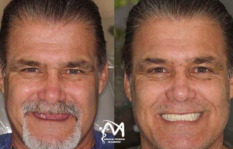 Dental implants transformation in Albania with the best prices. Patient showing results before and after procedure with dentists in Albania.