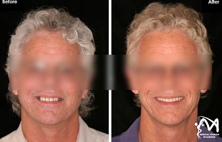 Dental Implants before and after the procedure results in Albania.