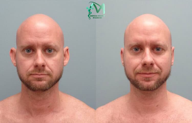 Ear Reduction surgery Albania.