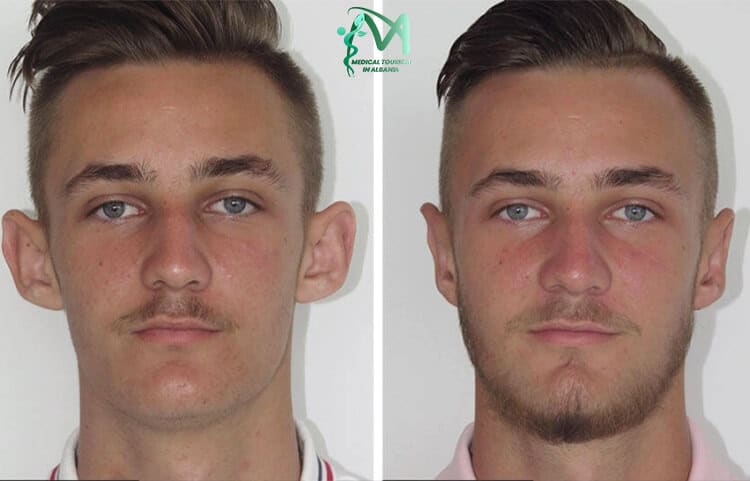 Ear reduction treatment Albania for smaller ears.