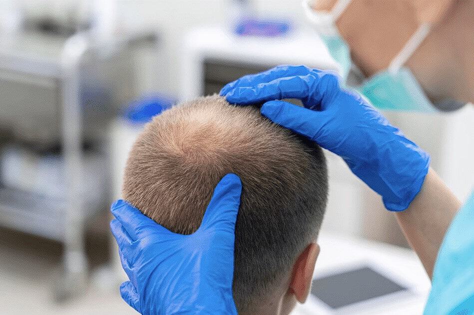 Image illustrating a hair transplant procedure in Albania.