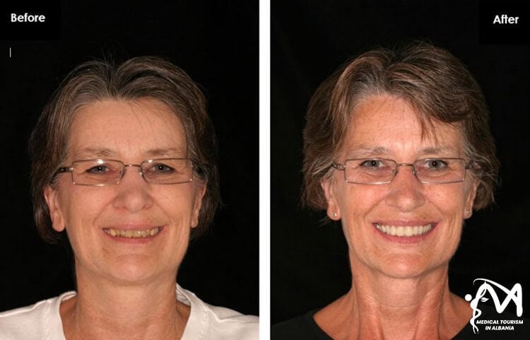 Implants procedure in Albania results before and after female patient.