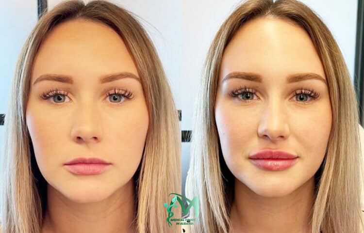 Lip filler surgery Albania.