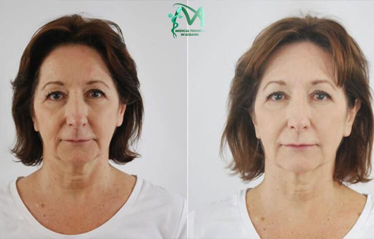 Mini face lift surgery in Tirana, Albania.