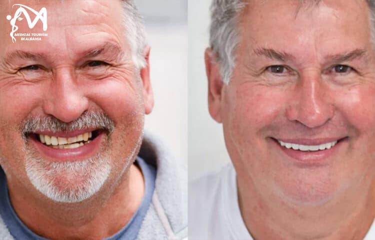 New smile makeover from tourist who trusted Medical Tourism in Albania for dental crown treatment in Albania.