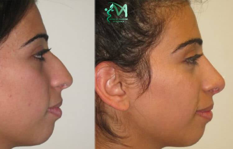 Nose reduction Albania smaller nose surgery.