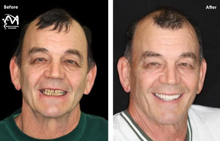 Patient from France who did teeth implants in Albania showing his amazing progress after 3 months