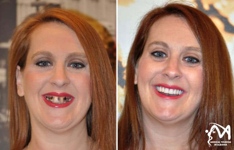 Permanent smile fix and teeth replacement transformation from a female patient in Albania with Medical Tourism Packages