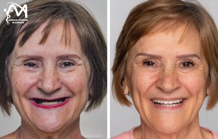 Smile transformation for senior women in Albania.