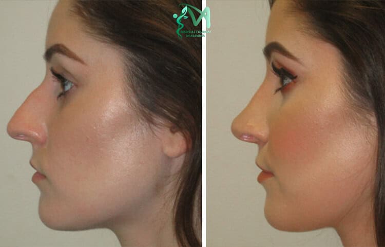 Rhinoplasty procedure in Albania. Smaller nose size Tirana.