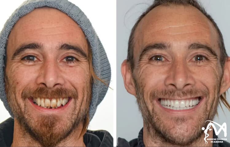 The results after full dental implants surgery on lower and upper arch are completed in Tirana, Albania