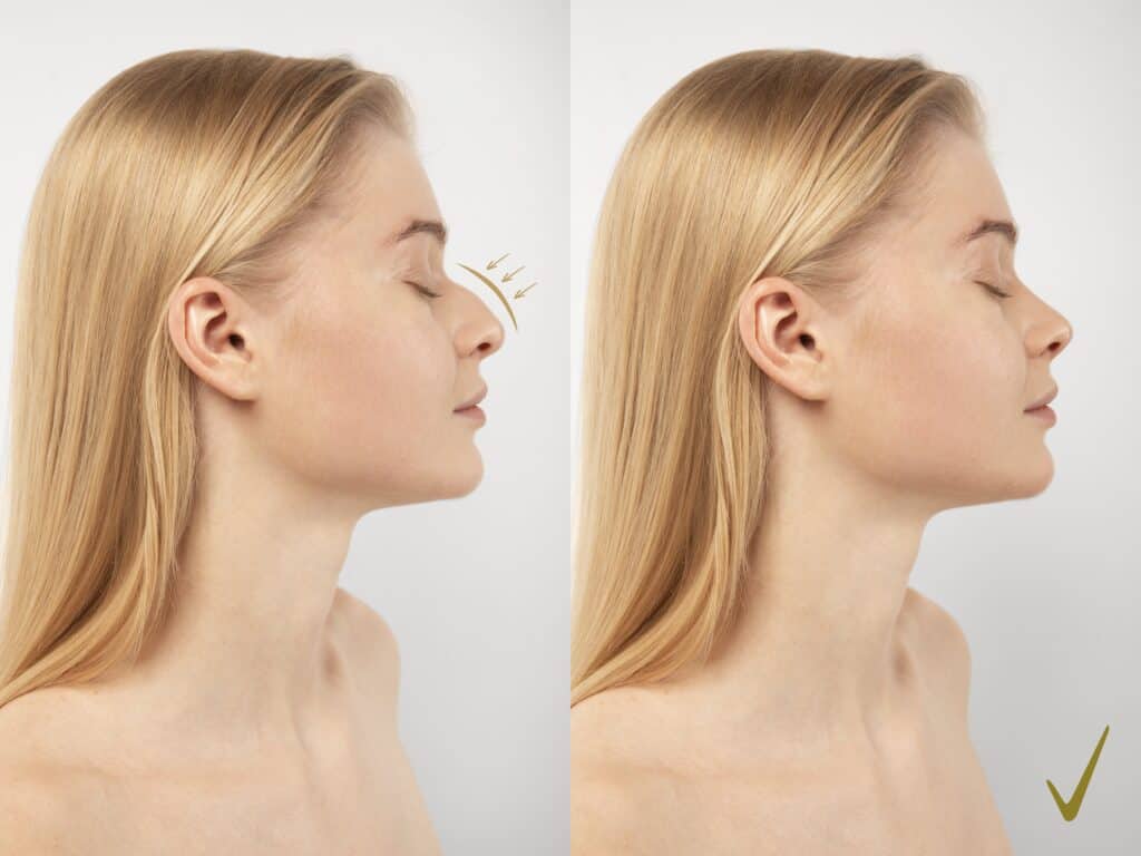 Image illustrating rhinoplasty in Albania before and after results