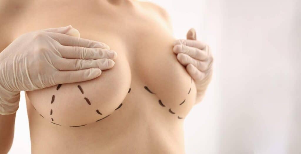 Woman's chest with markings for breast lift or augmentation procedure in Albania.