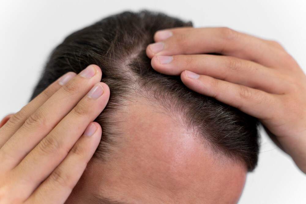 Man with a receding hairline.