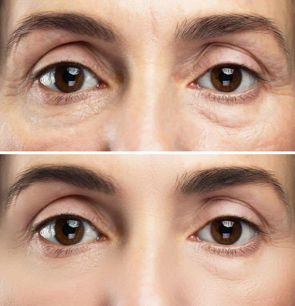 Avant et après une blépharoplastie pour paupières tombantes en Albanie.