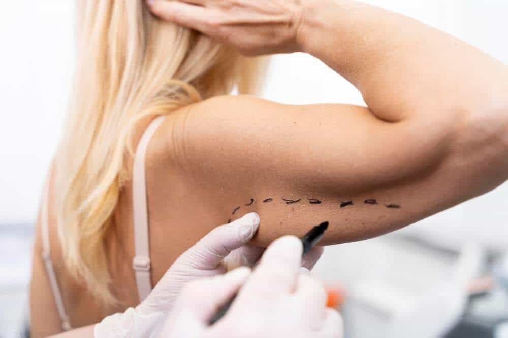 Behandeling voor armvetverwijdering in Albanië voor medisch toerisme.