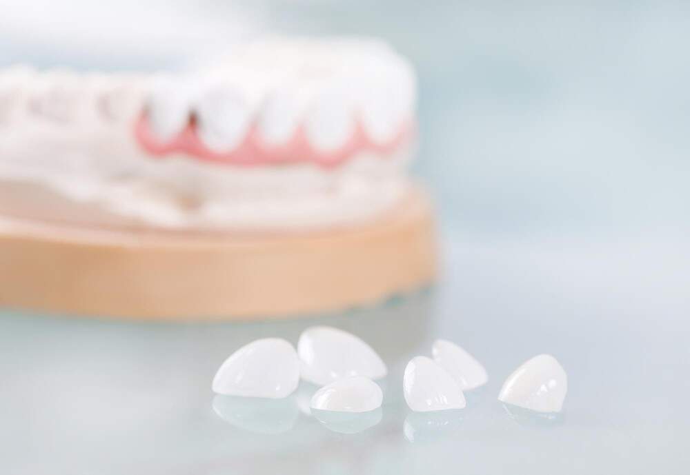 Dental veneer treatment in Albania