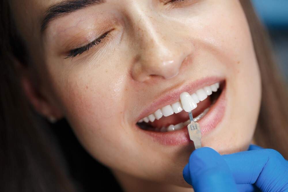 Kobieta otrzymująca licówkę lub koronę dentystyczną w ramach kosmetycznego leczenia stomatologicznego.