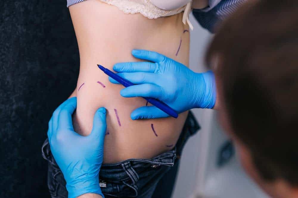 Medical procedure for body contouring in Albania, focusing on hourglass figure enhancement.