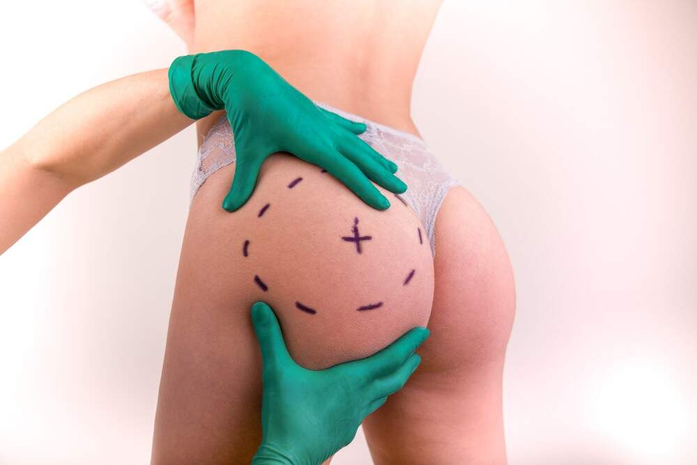 Medical procedure for body shaping in Albania, focusing on hourglass figure enhancement.