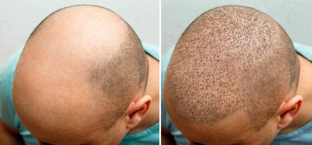 Cuoio capelluto maschile che mostra perdita di capelli prima e dopo il trapianto di capelli in Albania.