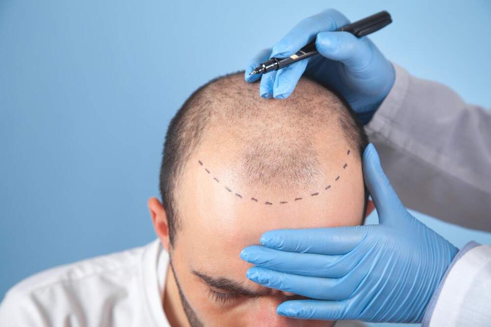 Professionista medico che esegue una procedura di trapianto di capelli sul cuoio capelluto di un uomo.