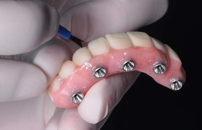 Denti in Albania: Correggere i denti in Albania