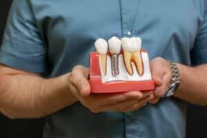 Implante dentare all-on-4 ne Shqiperi per zevendesimin e dhembeve