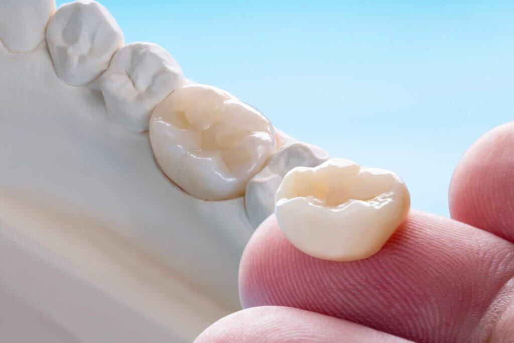 Pamje e afërt e kurorës dentare E-Max duke u vendosur në një model për restaurim dentar në Shqipëri.