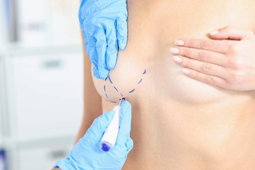 Chirurgia di riduzione del capezzolo per turismo medico in Albania.