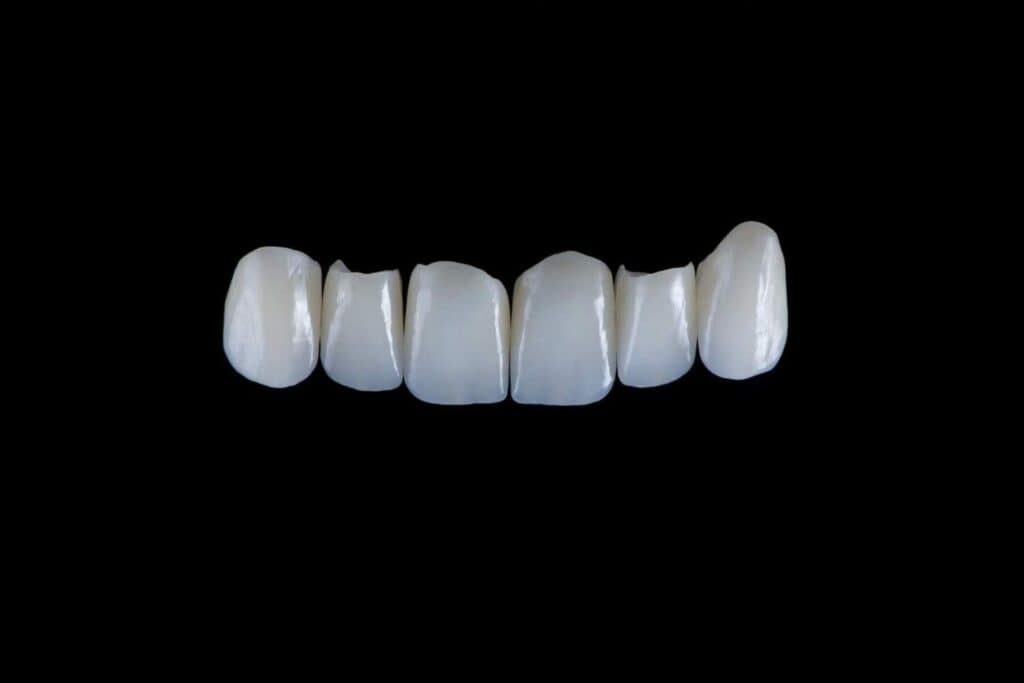 Kurora dentare E-Max me cilësi të lartë për buzëqeshje të përmirësuar dhe qëndrueshmëri.