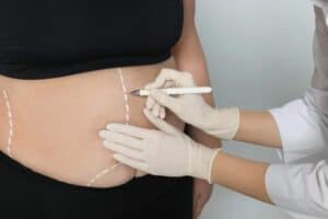 Safe and affordable liposuction treatment in Albania