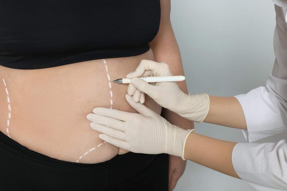 Foto që ilustron konsulten me kirurgun per një operacion "Mommy Makeover"