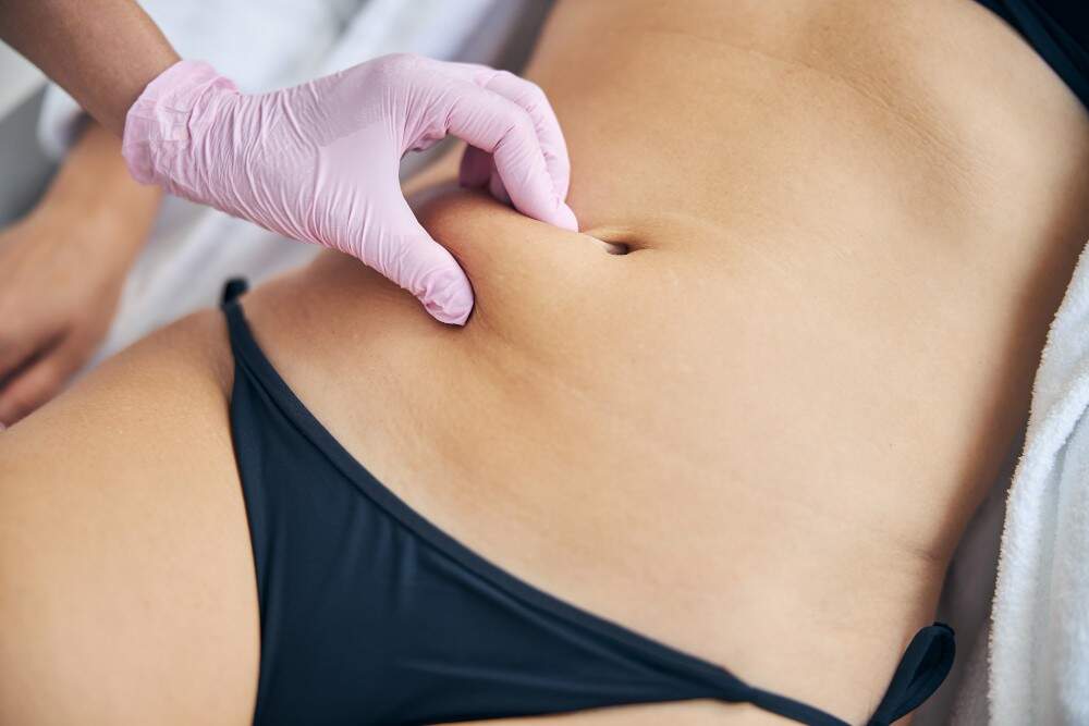 Affordable tummy tuck surgery in Albania