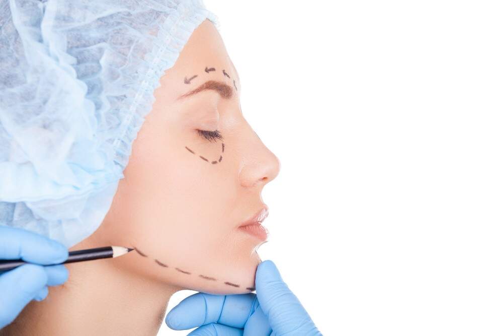 Image illustrating a facelift procedure