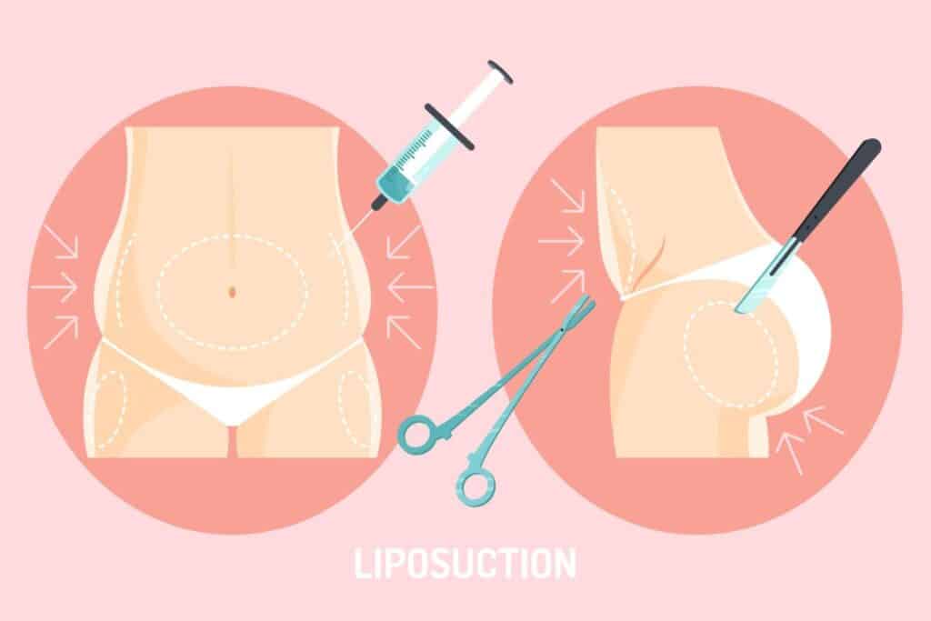 Medizinische Illustration des Fettabsaugungsverfahrens am Bauch und der Bauchdeckenstraffungstechnik.