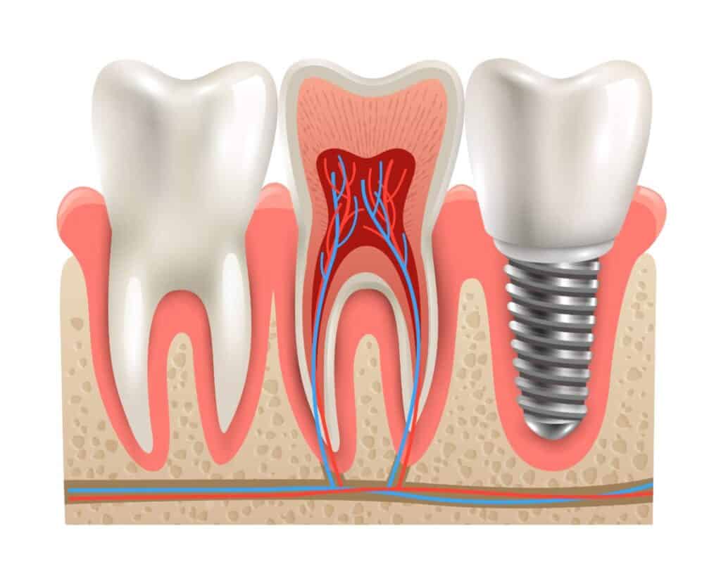 Sezione trasversale di un impianto dentale che mostra il tessuto gengivale e osseo circostante.