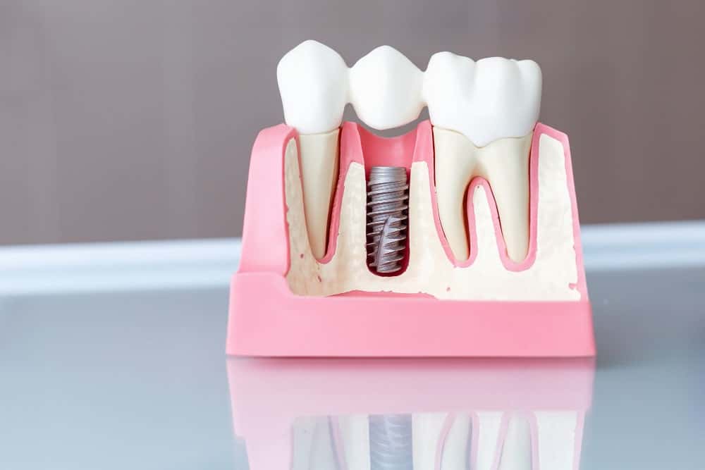 Implante dental con tornillo en un modelo que muestra la restauración dental paso a paso en Albania.